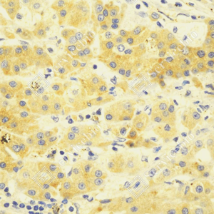 01 GB151312_Transferrin_ZCM20127_ZCM20127230824_d500_H_Liver cancer_40.0x_IHC.png