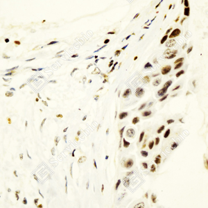 01 GB151843_Estrogen Receptor alpha_ZCM22038_ZCM22038230824_d1000_H_breast cancer_40.0x_IHC.png