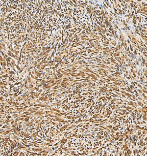 06 GB15689_AKT_H286_M009230825_d500_M subcutaneous nude mouse model of 4T1 cell_20.0x_IHC.png