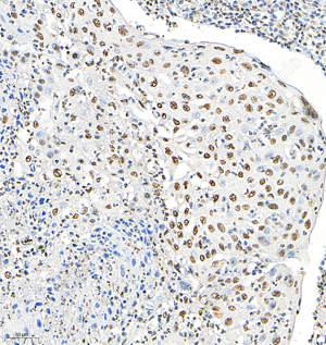 02 GB153380_Phospho-p38_H283_M008230825_d500_H cervical carcinoma_20.0x_IHC.png