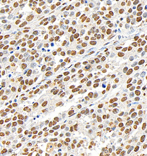 05 GB153380_Phospho-p38_H283_M008230825_d500_H gastric carcinoma_40.0x_IHC.png