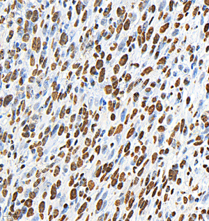 06 GB153380_Phospho-p38_H283_M008230825_d500_M subcutaneous nude mouse model of 4T1 cell_40.0x_IHC.png