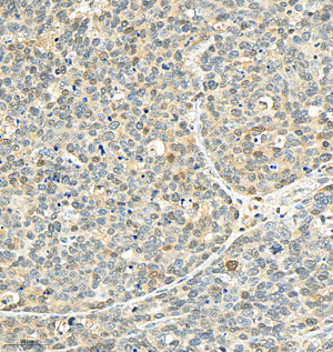 02 GB154685_P38_H297_M007230901_d500_H gastric carcinoma_25.3x_IHC-WM.png