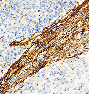 03 GB15091_Fibronectin_M19103（A209 210)__d1000_H esophageal carcinoma_25.0x_IHC_WM.png