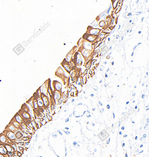 01 GB15801_Cytokeratin 13_M21109_A304_A305_d1000_H bladder cancer_40.0x_IHC_WM.png