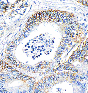 01 GB153899_Carbonic Anhydrase 9 CA9_R22132_(A367 A368)_d1000_H colon cancer_40x_IHC._WM.png