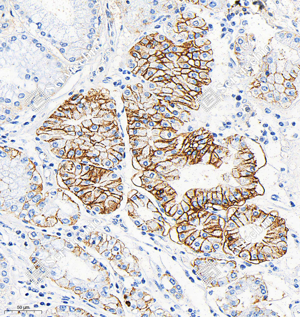 02 GB153899_Carbonic Anhydrase 9 CA9_R22132_(A367 A368)_d1000_H gastric carcinoma_23.7x_IHC_WM.png