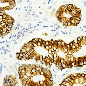 02 GB15231_Cytokeratin 8_ZSM21106_ZSM21106231106A_d500_H gastric carcinoma_40.0x_IHC_WM.png