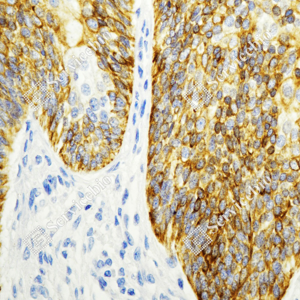 03 GB15363_Cytokeratin 17_ZSM21017_ZSM21017231106_d1000_H Laryngeal squamous cell carcinoma_40.0x_IHC_WM.png