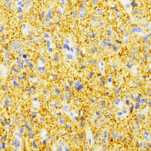 02 GB15814_synaptophysin_ZCR22128_ZCR22128231117_d500_H glioblastoma multiforme_40.0x_IHC_WM.png