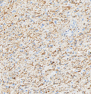 01 GB115685_Nestin-C3359-C335923082202_d500_H glioblastoma multiforme_20.0x_IHC_WM.png