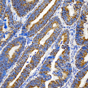 03 GB115691_DDIT3CHOP-C3202-C320223070402_d500_H colorectal adenocarcinoma_20.0x_IHC_WM.png