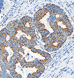 04 GB115691_DDIT3CHOP-C3202-C320223070402_d500_H colorectal adenocarcinoma_30.0x_IHC_WM.png