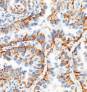 06 GB115691_DDIT3CHOP-C3202-C320223070402_d500_H Non-small cell lung cancer_28.1x_IHC_WM.png