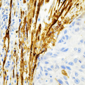 03 GB150005_Transglutaminase 2_ZCR195_ZCR195231114_d1000_H esophageal carcinoma_40.0x_IHC_WM.png