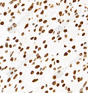 07 GB11102_Histone H3_C545_C54520111102_d500_H liver cancer_40.0x-IHC_WM.png