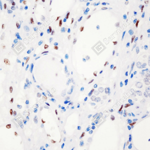 03 GB150001_Phospho-STAT3(Y705)_M006230810__d500_H renal carcinoma_40.0x-IHC_WM.png