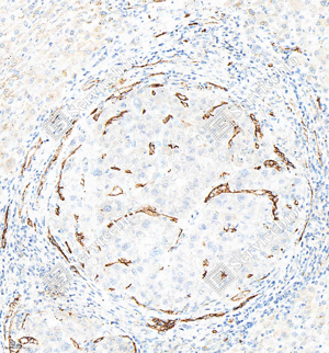 02 GB15013_CD34_M015_d100_liver cancer_20.0x_IHC_WM.png