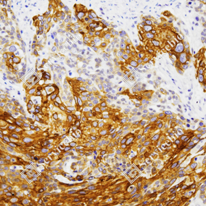 03 GB151247_Cytokeratin 6_ZSR22059_ZSR22059231208_d700_H esophageal carcinoma_20.0x_IHC_WM.png