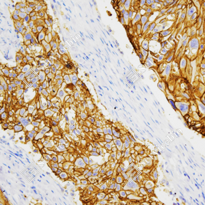 02 GB152543_Claudin 1_ZCR22092_ZCR22092231209_d500_H esophageal carcinoma_20.0x_IHC_WM.png