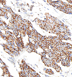 02 GB154122_Bax_M016_d100_H esophageal carcinoma_40.0x_IHC_WM.png