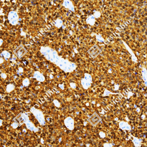 02 GB151213_BLBP_ZCM20001_ZCM20001231204_d8000 H glioblastoma multiforme_20.0x_IHC_WM.png