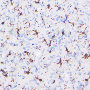02 GB123502_Iba1-7E10E3_7E10E320240110_d4000_H glioblastoma multiforme_40.0x_IHC_WM.png