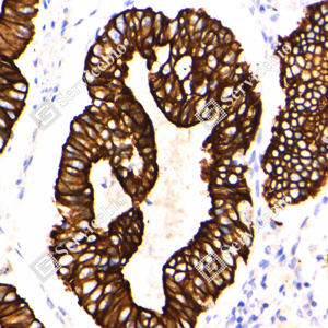 02 GB150009_Acidic Cytokeratin_ZCR21113240205_d4000_H endometrial cancer_40x_IHC_WM.png