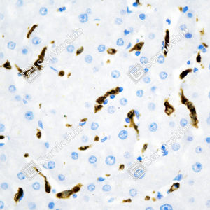 06 GB15104_Heme Oxygenase 1_d500_liver cancer_40x_IHC_WM.png