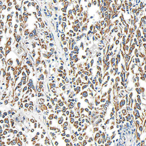 02 GB115633_ULK2_C3305_C330523071802_d300_H gastric carcinoma_25.0x_IHC_WM.png