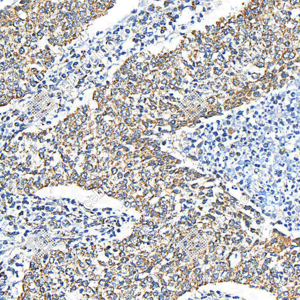 03 GB115633_ULK2_C3305_C330523071802_d300_H Lung squamous cell carcinoma_25.0x_IHC_WM.png