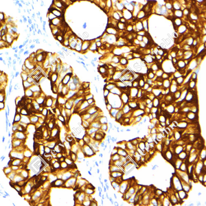 04 GB15232_Cytokeratin 18_ZSM21018240307B_d500_H endometrial cancer_40.0x_IHC_WM.png