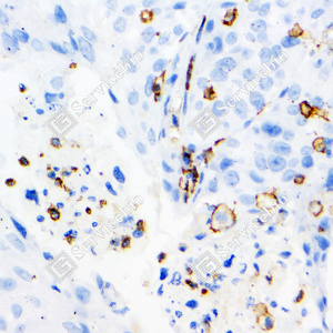 04 GB120004_MMP9_2-6D8_d300_H lung cancer_40.0x_IHC_WM.png