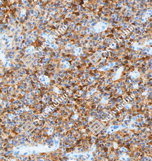 04 GB151177_Glutamine Synthetase_ZCM20003240223_ZCM20003_d5000_H glioblastoma_20.0x_IHC_WM.png