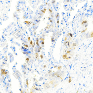 02 GB155510_Thymidylate Synthase_ZCM22146240222_ZCM22146_d1000_H lung cancer_20.0x_IHC_WM.png