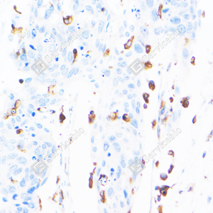 02 GB151025_Fascin_ZSM22048240423_d500_H cervical carcinoma_40.0x_IHC_WM.png