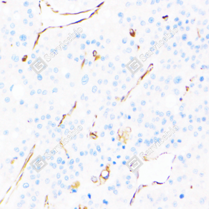 03 GB151025_Fascin_ZSM22048240423_d500_H liver cancer_40.0x_IHC_WM.png