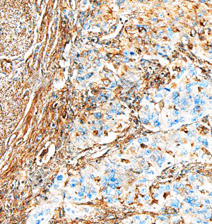 02 GB151264_Annexin-6 ANXA6_ZSM20007_ZSM20007240423_d1000_H endometrial Cancer_20.0x_IHC_WM.png