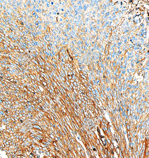 03 GB151264_Annexin-6 ANXA6_ZSM20007_ZSM20007240423_d1000_H esophageal carcinoma_20.0x_IHC_WM.png