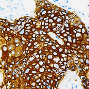 02 GB151648_Cytokeratin 15_ZCM21016_ZCM21016240402_d500_H esophageal cancer_40.0x_IHC_WM.png