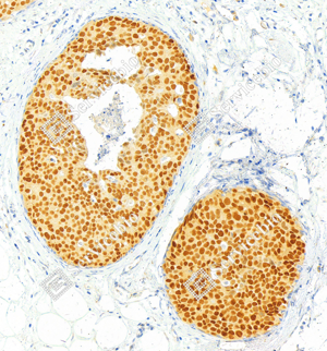 02 GB151845_Estrogen Receptor alpha__ZSM22058240423_d500_H breast cancer_20.0x_IHC_WM.png