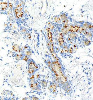 04 GB151845_Estrogen Receptor alpha__ZSM22058240423_d500_H breast cancer_36.5x_IHC_WM.png