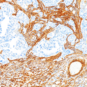 03 GB15960_Caldesmon CDM_ZSM22178_ZSM22178240423_d3000_H ovarian cancer_13.0x_IHC_WM.png