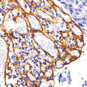 05 GB115707_Collagen I_C1758_C175822012502_d1000_H esophageal carcinoma_40.0x_IHC_WM.png