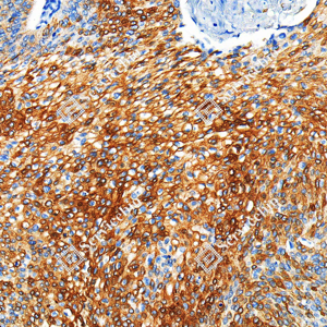 05 GB115708_MMP1_C3754_C375424040802_d1000_H esophageal carcinoma_20.0x_IHC_WM.png