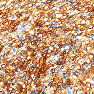 06 GB115708_MMP1_C3754_C375424040802_d1000_H esophageal carcinoma_40.0x_IHC_WM.png