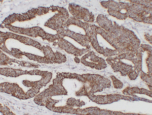 01 GB14098 HSP60 H colon carcinoma d200_IHC.png