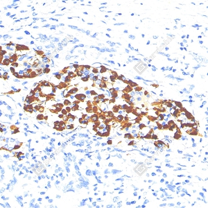 02 YB115778_Pro-glucagon_CB091_CB09124100103_d2400_H pancreatic carcinoma_30.0x_IHC_WM.jpg