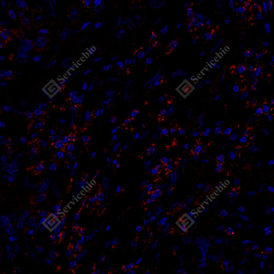 02 .H胃癌 7500 1：500  IF ACADM红 J_57.7x_IF_WM.jpg