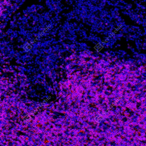 8 GB150126_CD1a_red_mAb126_mAb12625070302 d7000 H thymoma_20.0x_IF_WM.jpg